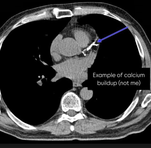 Example of calcium buildup in cardiac artery