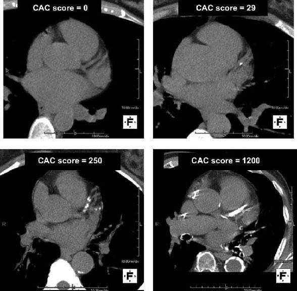 Four levels of cardiac buildup via CT Scan